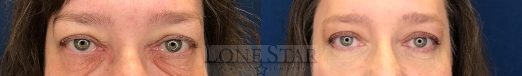 Before & After Blepharoplasty Case 211 Front View in Frisco, TX