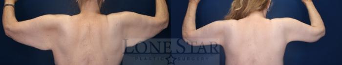 Before & After Brachioplasty Case 199 Back View in Frisco, TX
