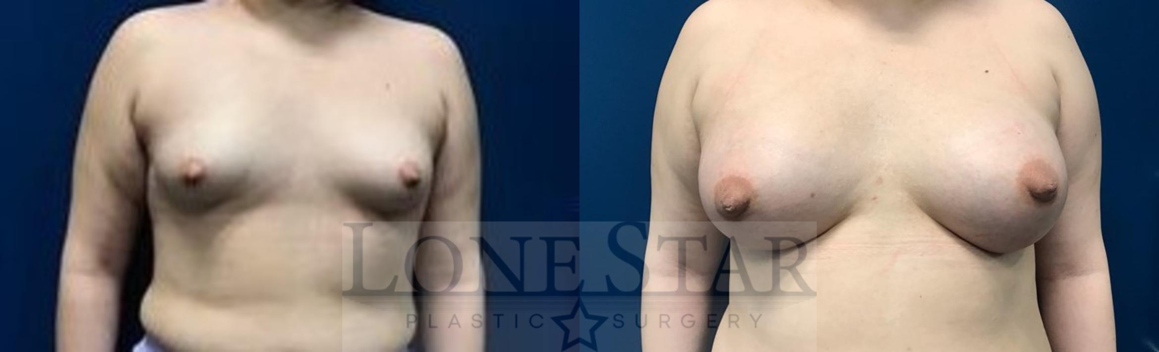 Breast Augmentation Case 6 Before & After View #1 | Frisco, TX | Lone Star Plastic Surgery: Dr. Sean Hill