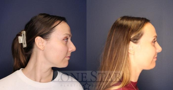 Before & After Rhinoplasty Case 219 Right Side View in Frisco, TX