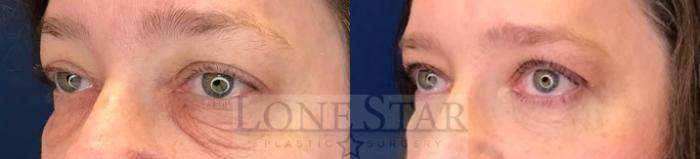 Before & After Blepharoplasty Case 211 Left Oblique View in Frisco, TX