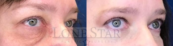 Before & After Blepharoplasty Case 211 Right Oblique View in Frisco, TX