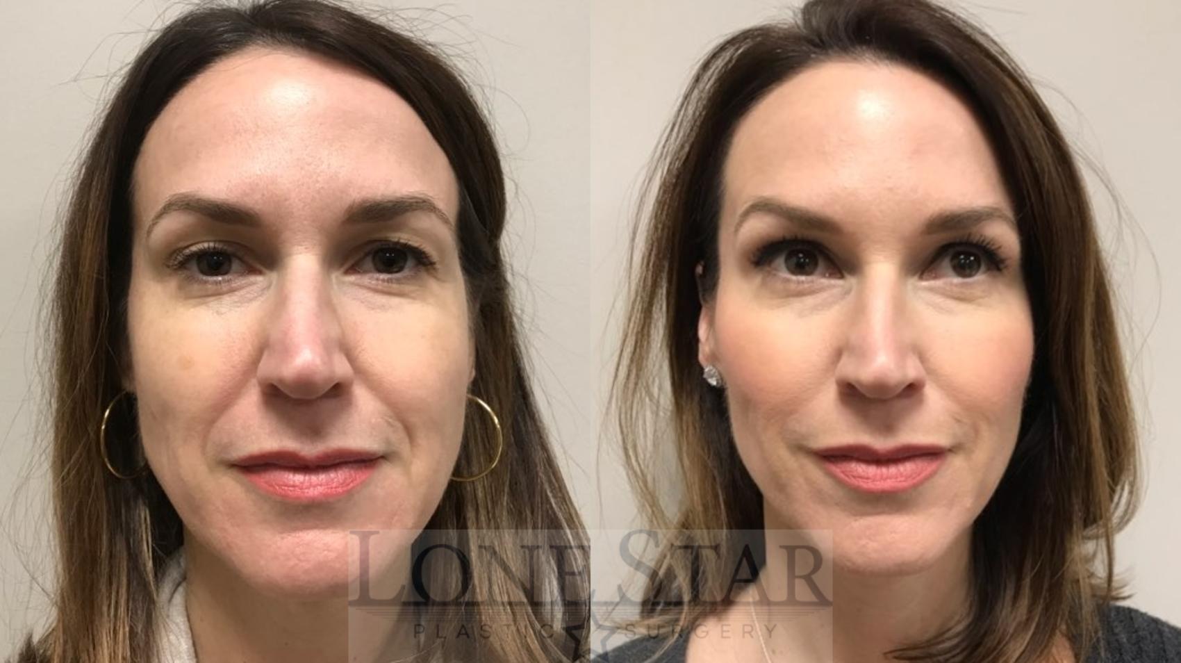 Before & After BOTOX® Cosmetic & Dysport® Case 7 View #1 View in Frisco, TX