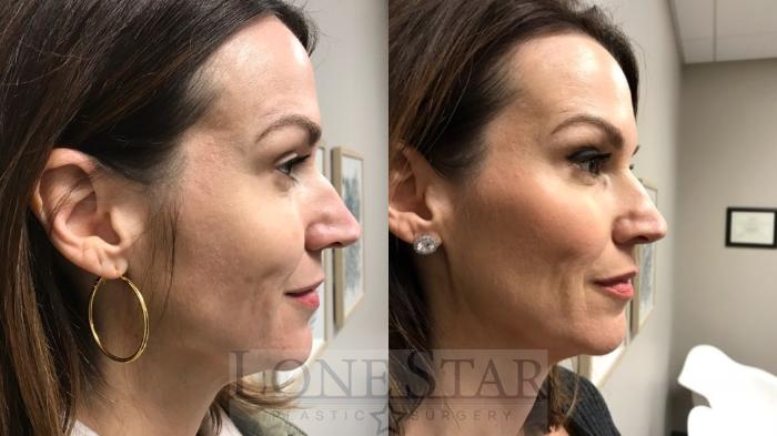 Before & After BOTOX® Cosmetic & Dysport® Case 7 View #2 View in Frisco, TX