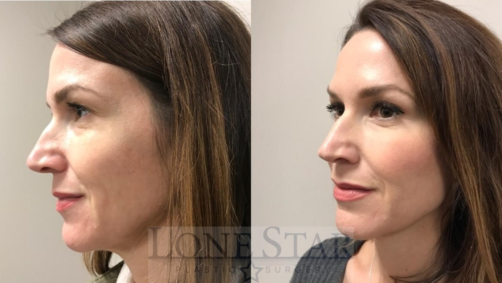 Before & After BOTOX® Cosmetic & Dysport® Case 7 View #3 View in Frisco, TX