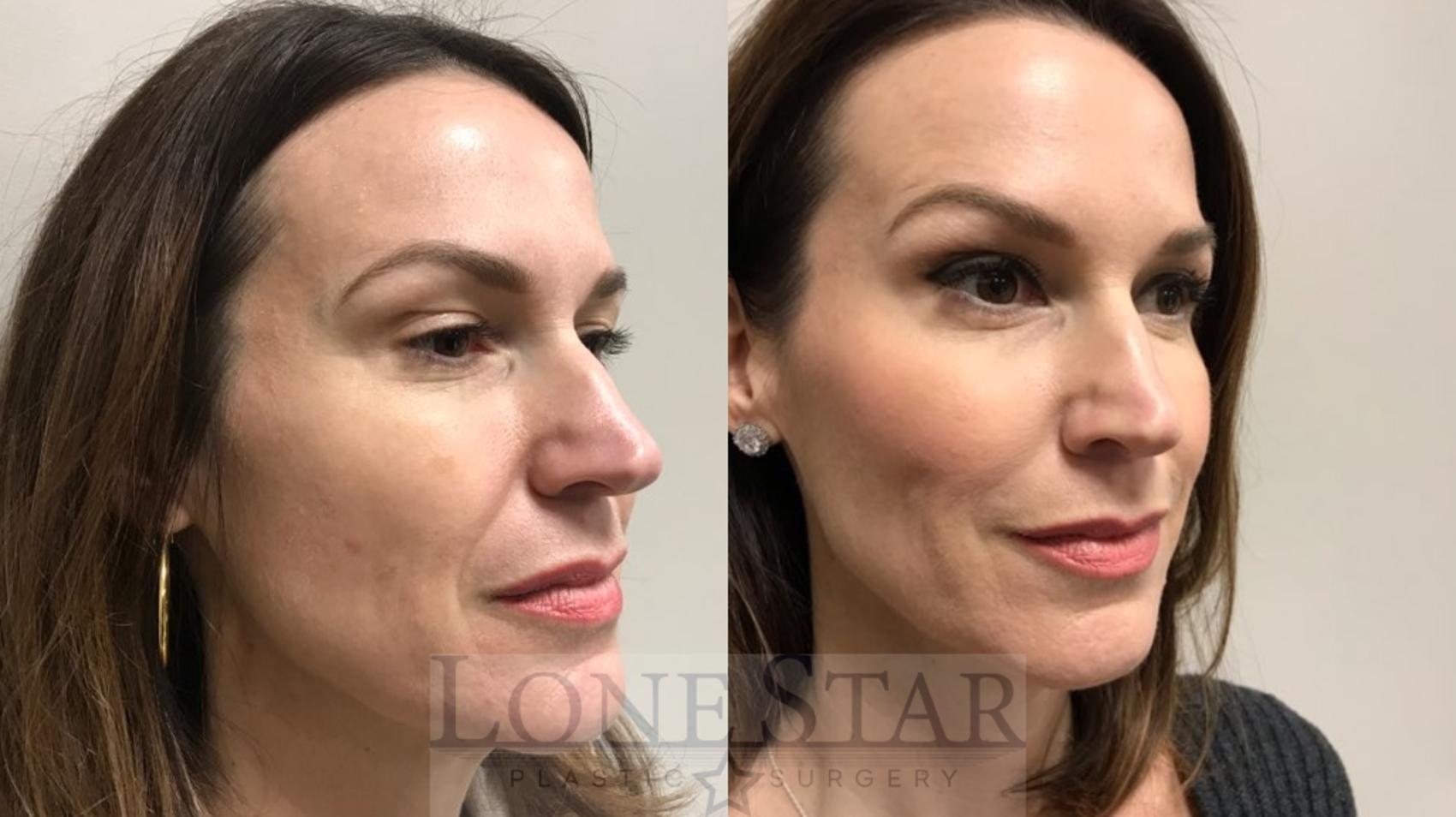 Before & After BOTOX® Cosmetic & Dysport® Case 7 View #4 View in Frisco, TX