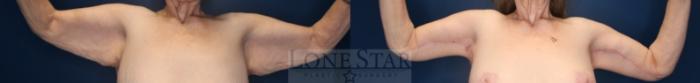 Before & After Brachioplasty Case 199 Front View in Frisco, TX