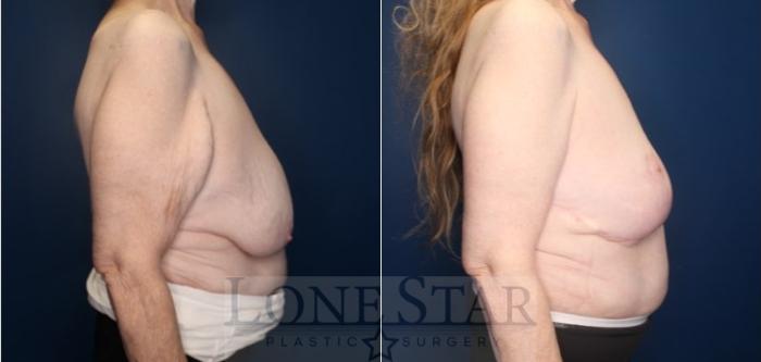 Before & After Brachioplasty Case 199 Right Side View in Frisco, TX