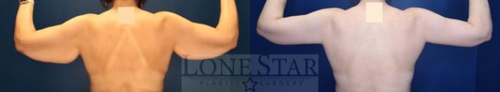 Before & After Brachioplasty Case 213 Back View in Frisco, TX