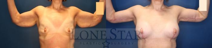 Before & After Brachioplasty Case 213 Front View in Frisco, TX