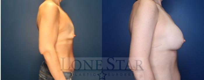 Before & After Brachioplasty Case 213 Right Side View in Frisco, TX