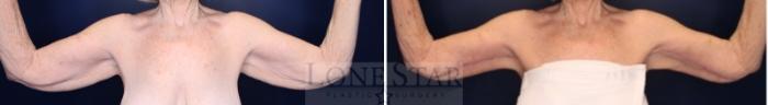 Before & After Brachioplasty Case 214 Front View in Frisco, TX