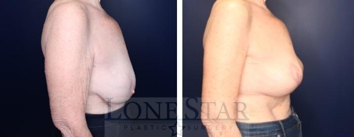 Before & After Brachioplasty Case 214 Right Side View in Frisco, TX