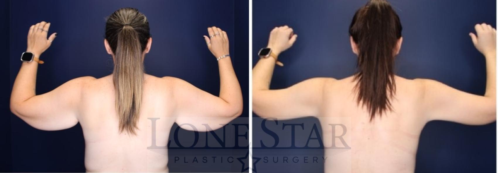 Before & After Brachioplasty Case 223 Back View in Frisco, TX