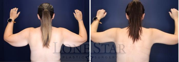 Before & After Brachioplasty Case 223 Back View in Frisco, TX