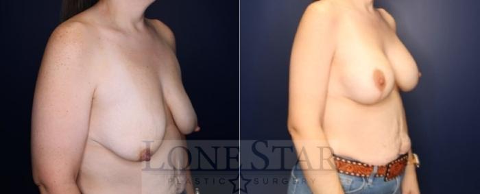 Before & After Brachioplasty Case 223 Left Oblique View in Frisco, TX