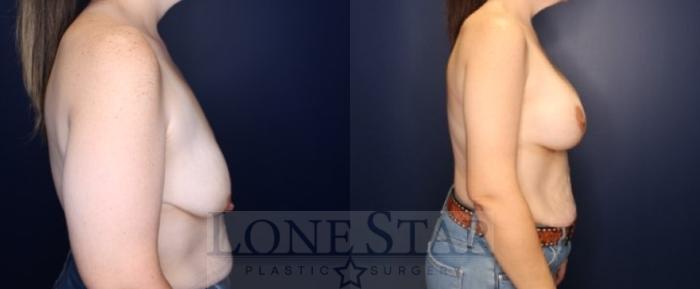 Before & After Brachioplasty Case 223 Left Side View in Frisco, TX