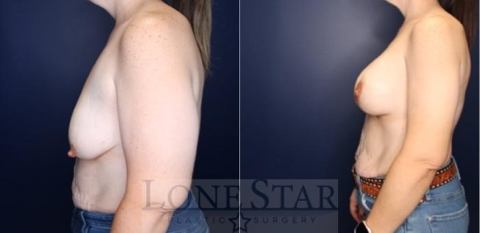 Before & After Brachioplasty Case 223 Right Side View in Frisco, TX