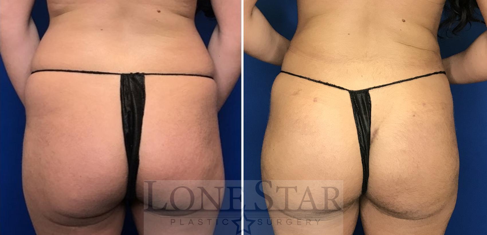Before & After Brazilian Butt Lift (BBL) Case 104 Back View in Frisco, TX
