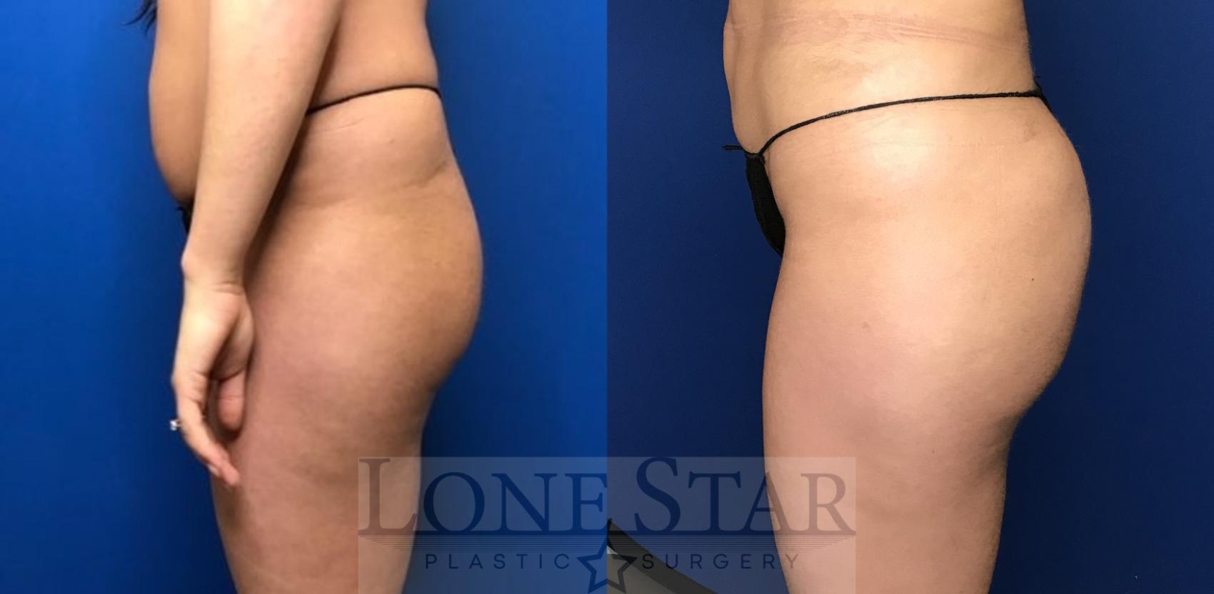 Before & After Brazilian Butt Lift (BBL) Case 104 Left Side View in Frisco, TX