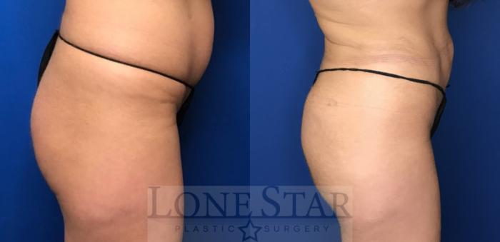 Before & After Brazilian Butt Lift (BBL) Case 104 Right Side View in Frisco, TX