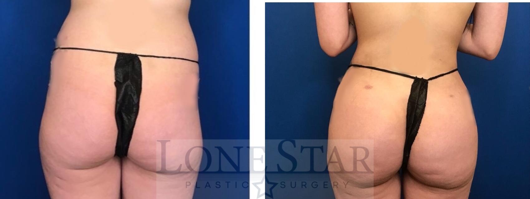 Before & After Liposuction Case 106 Back View in Frisco, TX