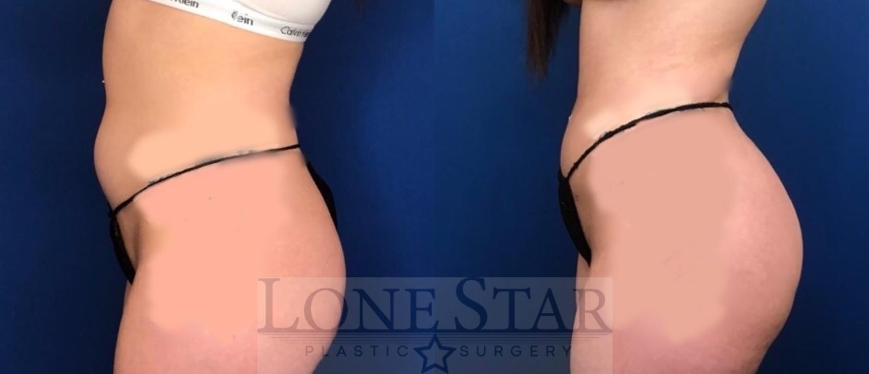 Before & After Brazilian Butt Lift (BBL) Case 106 Left Side View in Frisco, TX