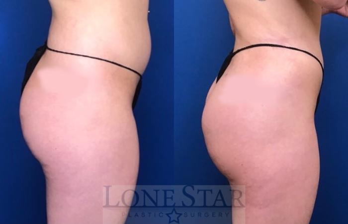 Before & After Brazilian Butt Lift (BBL) Case 106 Right Side View in Frisco, TX