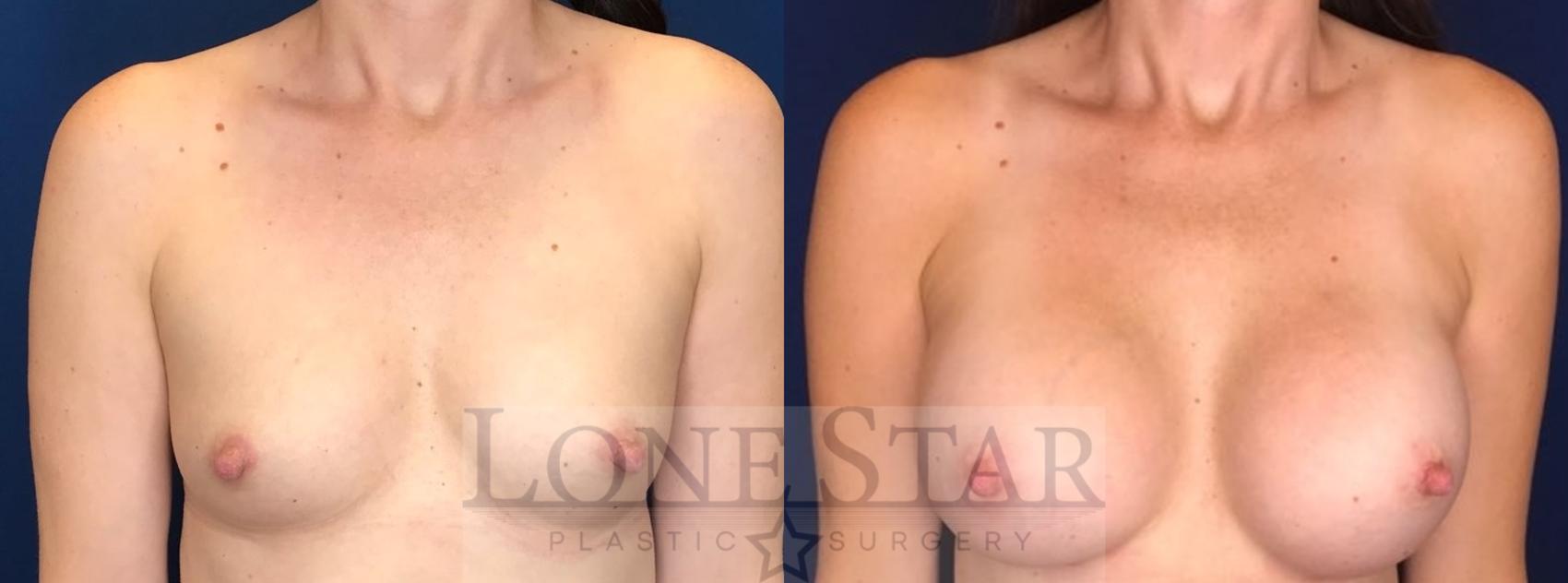 Before & After Breast Augmentation Case 100 Front View in Frisco, TX