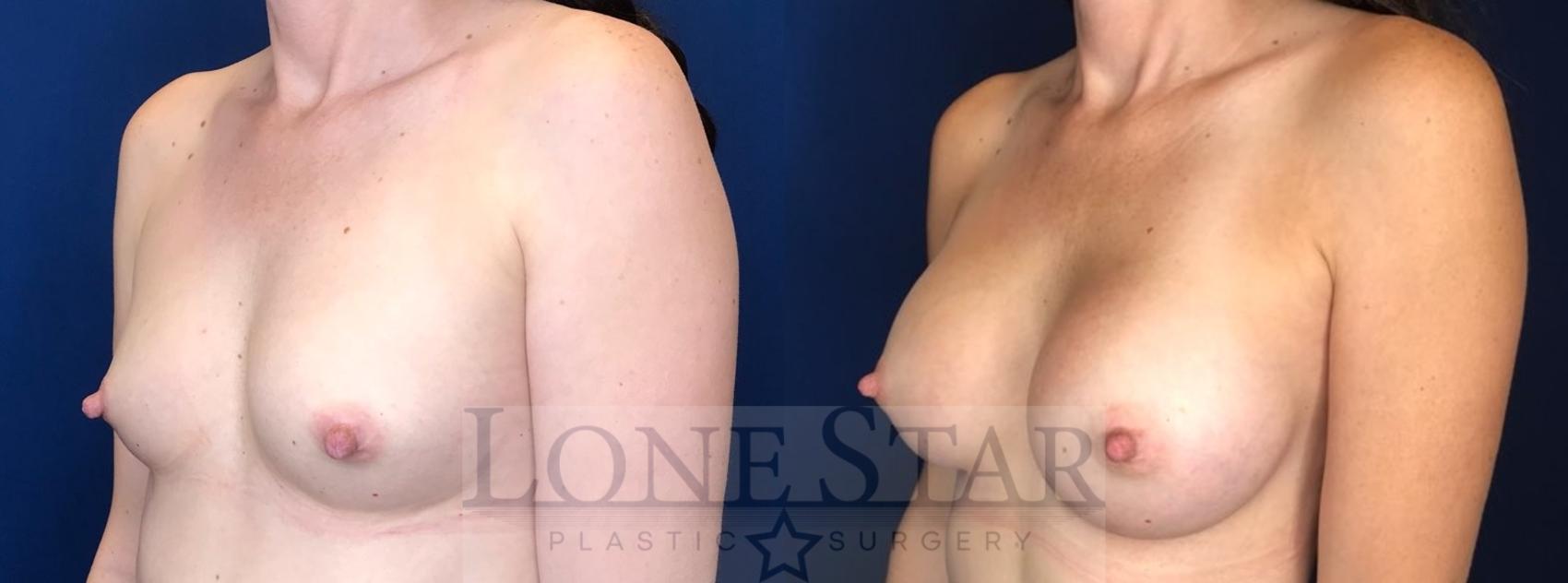 Before & After Breast Augmentation Case 100 Left Oblique View in Frisco, TX