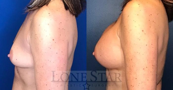 Before & After Breast Augmentation Case 108 Left Side View in Frisco, TX
