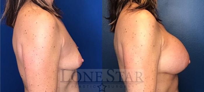 Before & After Breast Augmentation Case 108 Right Side View in Frisco, TX