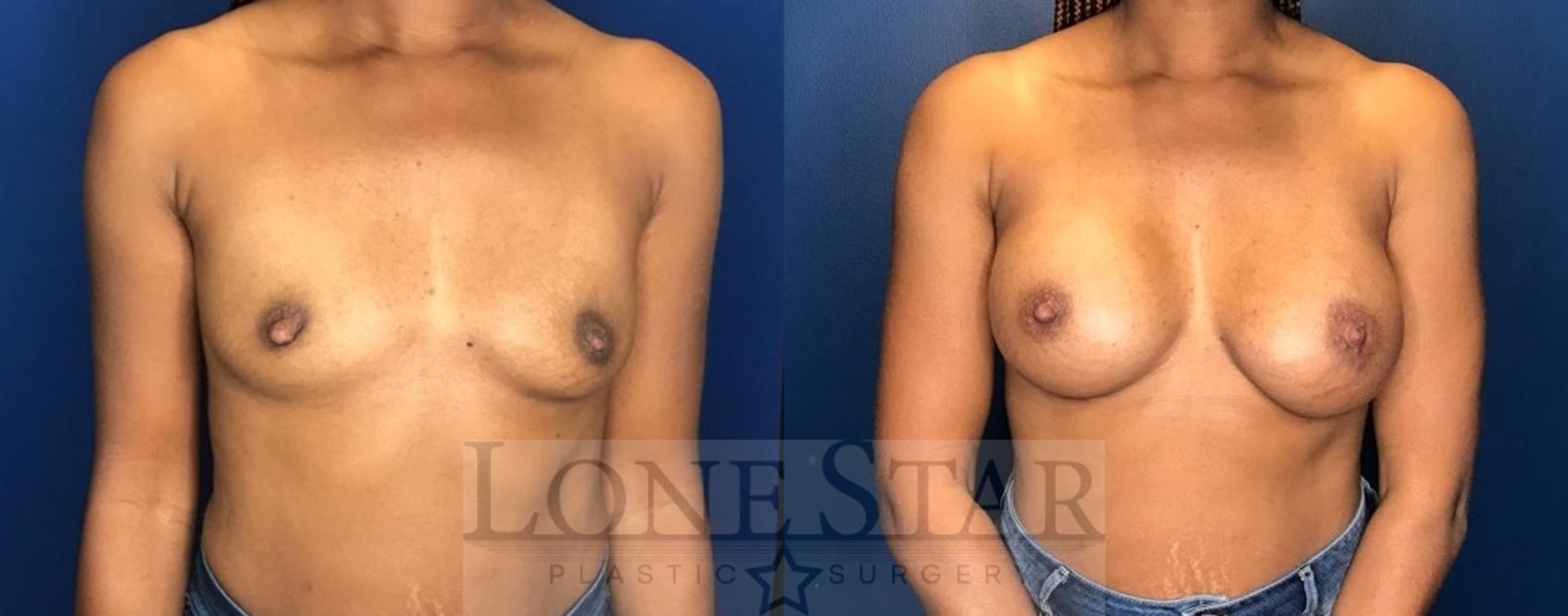 Before & After Breast Augmentation Case 109 Front View in Frisco, TX