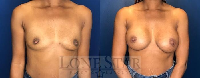 Before & After Breast Augmentation Case 109 Front View in Frisco, TX