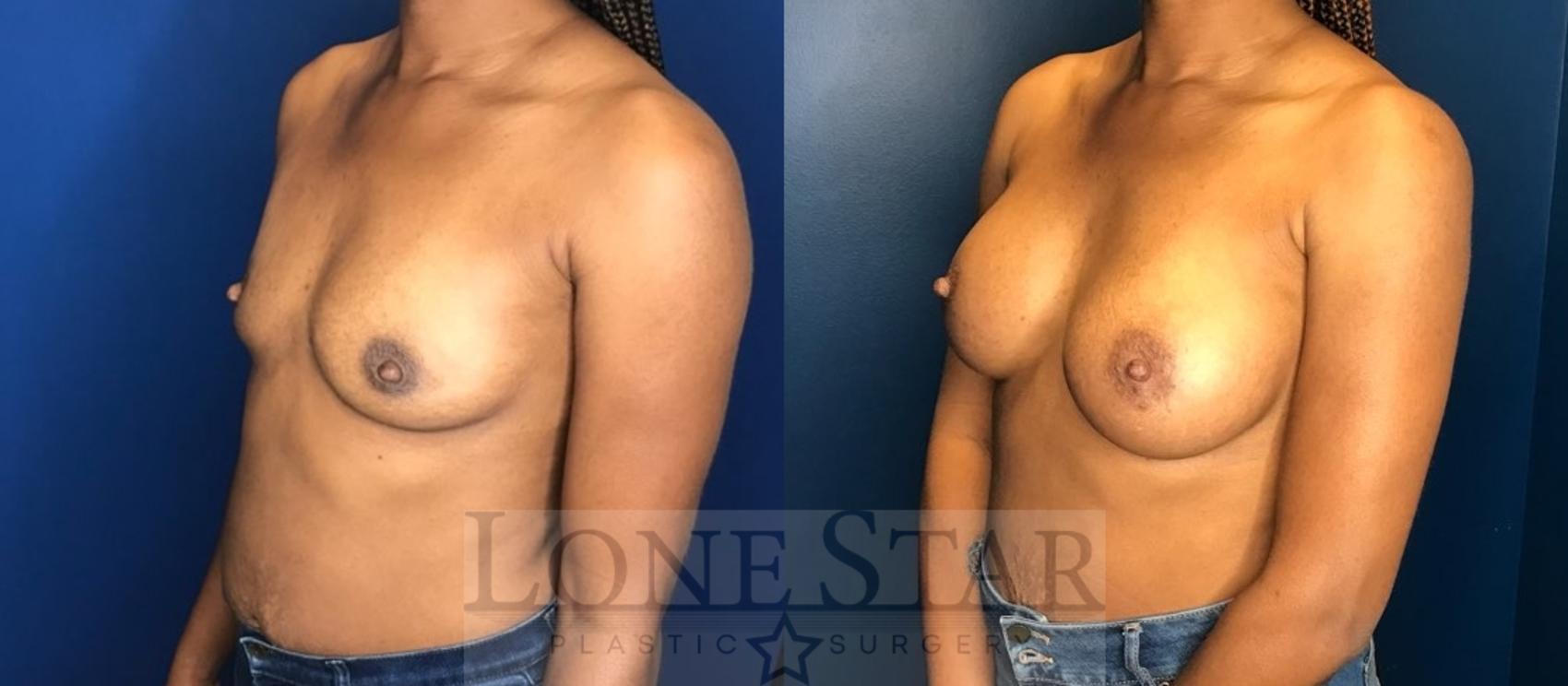 Before & After Breast Augmentation Case 109 Left Oblique View in Frisco, TX