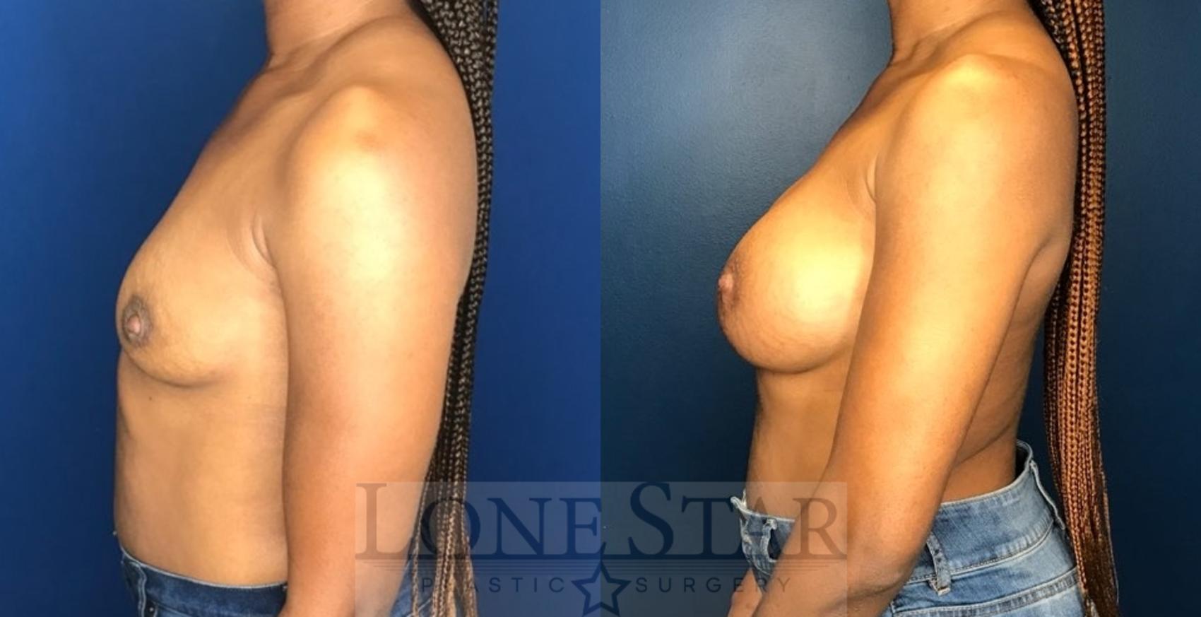 Before & After Breast Augmentation Case 109 Left Side View in Frisco, TX