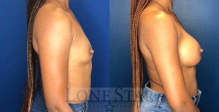 Before & After Breast Augmentation Case 109 Right Side View in Frisco, TX
