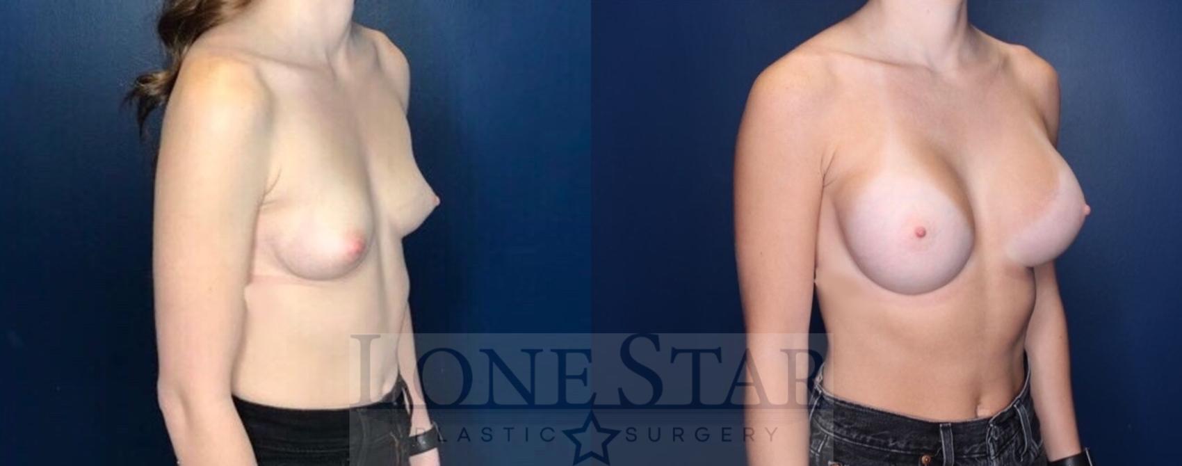 Before & After Breast Augmentation Case 112 Right Oblique View in Frisco, TX