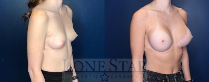 Before & After Breast Augmentation Case 112 Right Oblique View in Frisco, TX
