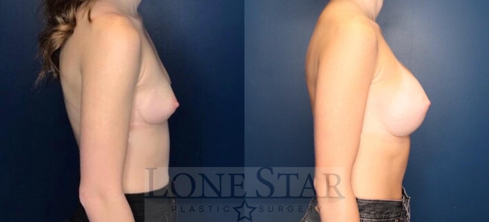 Before & After Breast Augmentation Case 112 Right Side View in Frisco, TX