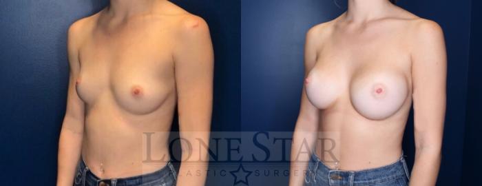 Before & After Breast Augmentation Case 113 Left Oblique View in Frisco, TX