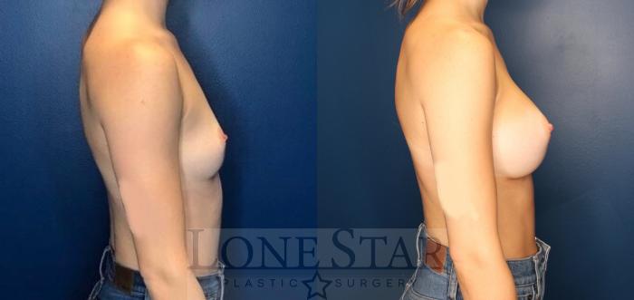 Before & After Breast Augmentation Case 113 Right Side View in Frisco, TX