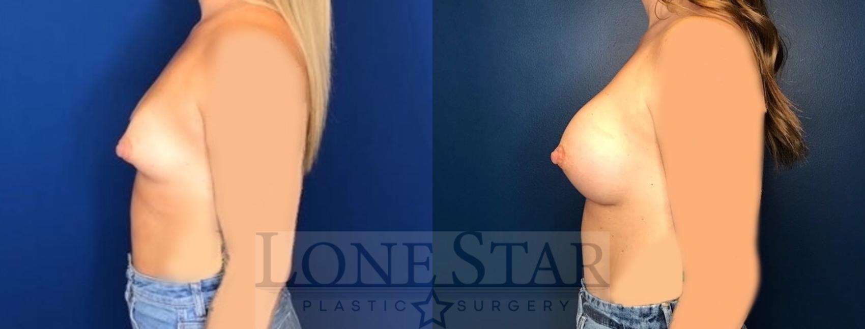 Before & After Breast Augmentation Case 115 Left Side View in Frisco, TX