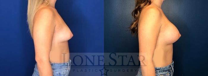 Before & After Breast Augmentation Case 115 Right Side View in Frisco, TX