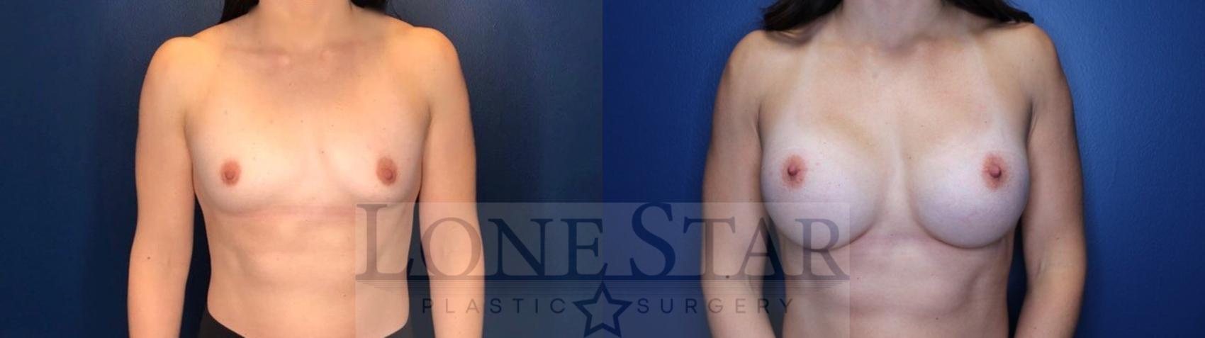 Before & After Breast Augmentation Case 118 Front View in Frisco, TX