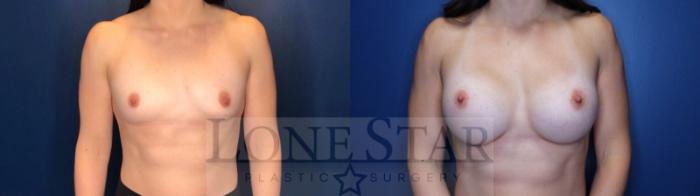 Before & After Breast Augmentation Case 118 Front View in Frisco, TX