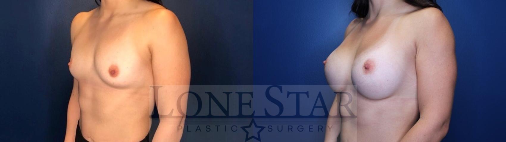 Before & After Breast Augmentation Case 118 Left Oblique View in Frisco, TX