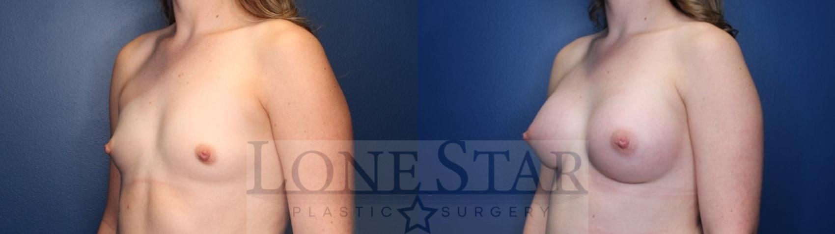 Before & After Breast Augmentation Case 119 Left Oblique View in Frisco, TX