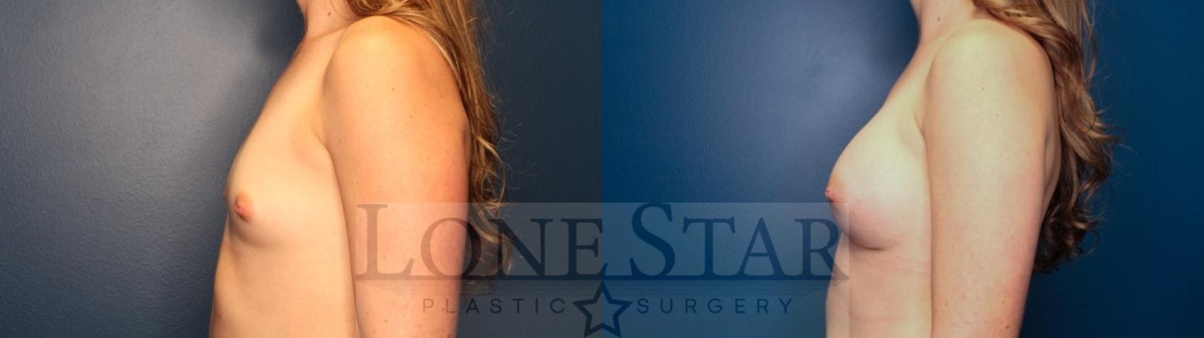 Before & After Breast Augmentation Case 119 Left Side View in Frisco, TX
