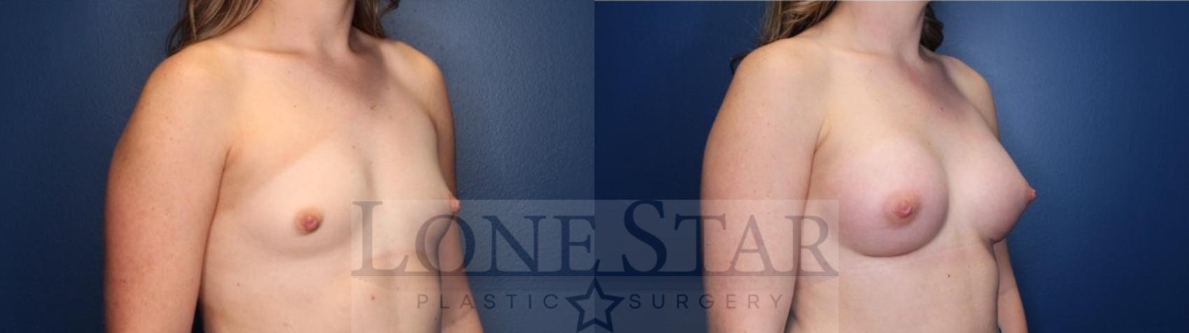 Before & After Breast Augmentation Case 119 Right Oblique View in Frisco, TX